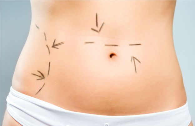 Abdominoplastia