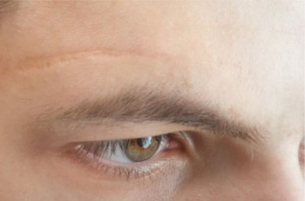 Revisión de Cicatrices